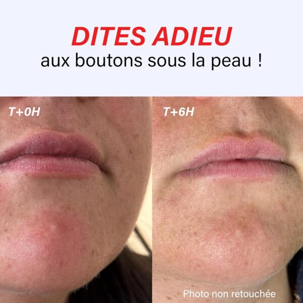 Kit complet SOS PATCHS Boutons – MYSOSBEAUTY – Image 3